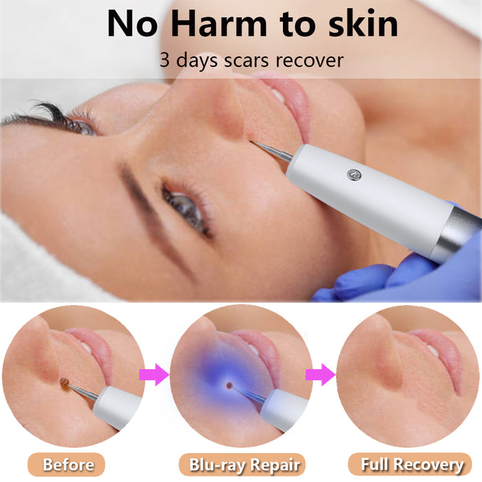 Skin Tag Remover Electric Warts Removal on Neck Eyelid Kit Tools with Home Usage USB Charging