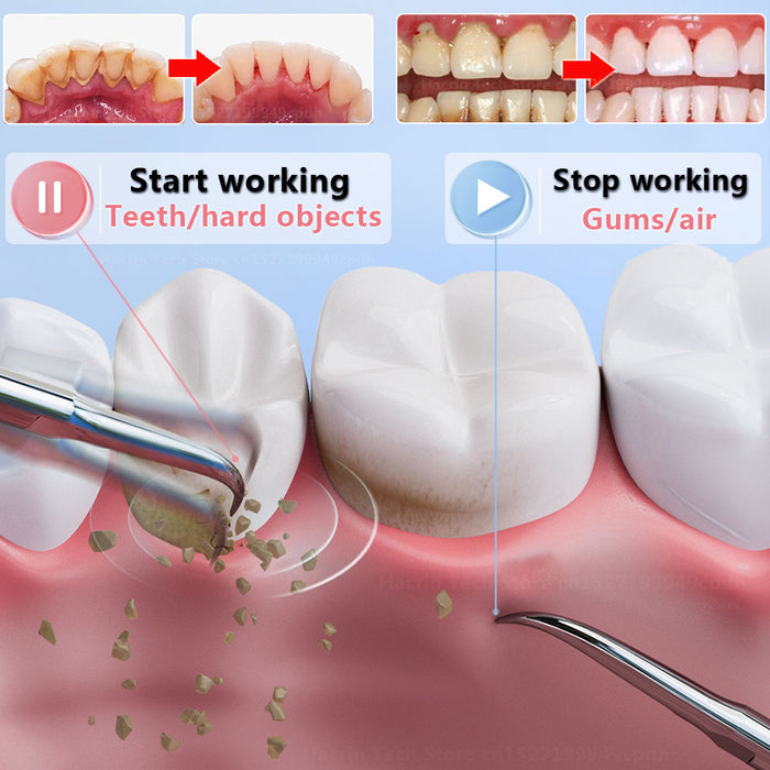 Dissolvant de plaque pour les dents dissolvant de tartre pour les dents avec lumière LED outils dentaires rechargeable sans danger pour les enfants adultes